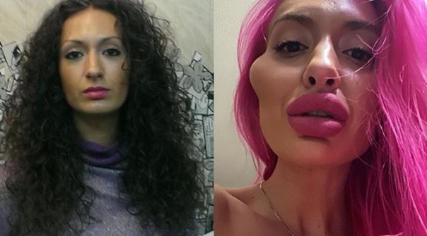 Anastasiia Pokreshchuk before and after surgery