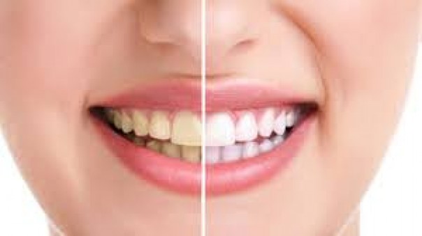 Here 5 Natural Ways to Make Your Teeth Whiter With Houses Products